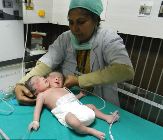 baby-with-two-heads-indian-mother-too-poor-to-have-an-ultrasound-gives